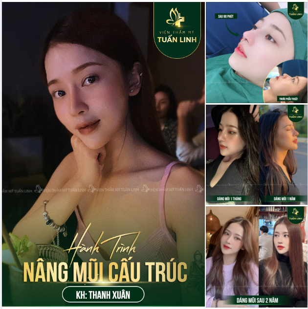 Hành trình nâng mũi cấu trúc của cô nàng Thanh Xuân