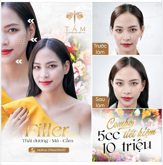 Hãy đẹp mỗi ngày, đừng chỉ đẹp khi cần Sau 45 phút thực hiện Combo FILLER