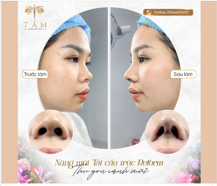 Hình ảnh khách hàng trước và ngay sau khi nâng mũi tái cấu trúc Reform kết hợp thu gọn cánh mũi quá khác biệt!