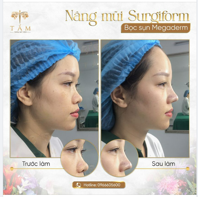 Hình ảnh so sánh trước và ngay sau nâng mũi Surgiform cho khách hàng TMV Tấm.