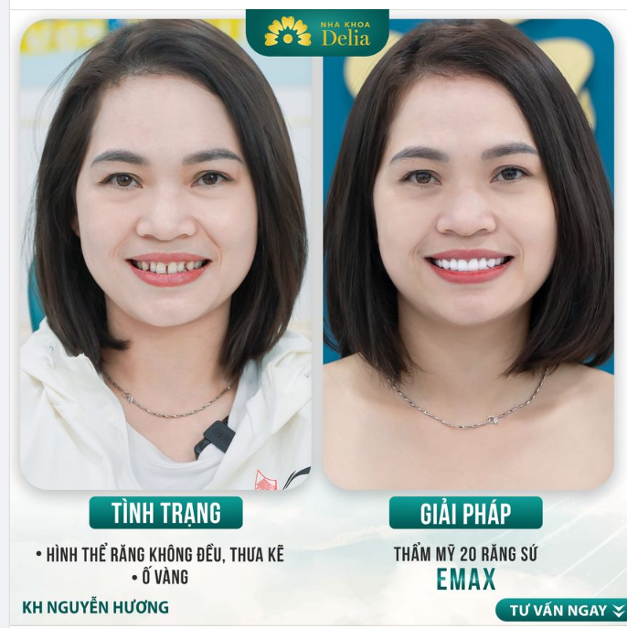 Hình thể răng không đều, thưa kẽ, chị Hương đã quyết định chọn Delia là nơi gửi gắm nụ cười.