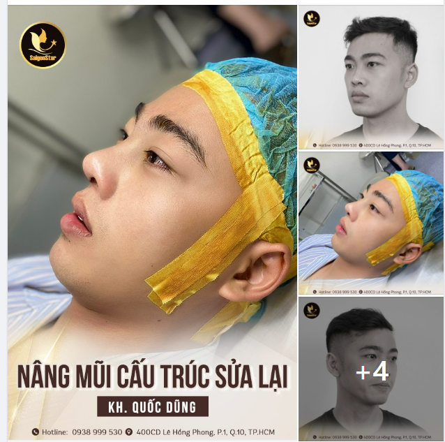HÓA NAM THẦN SAU NÂNG MŨI SỬA LẠI