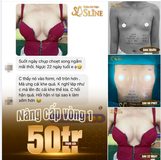 hối hận vì không làm ngực sớm hơn  feedback nâng ngực sau 22 ngày tuổi với Ekip Sline.