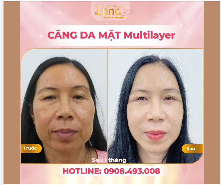 HỒI XUÂN THẦN TỐC CHỈ SAU 1 THÁNG