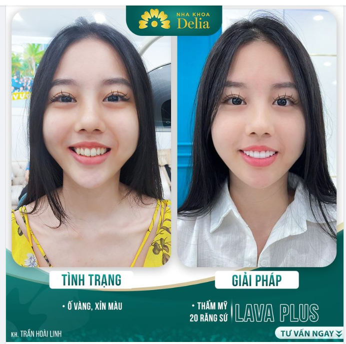 Hotgirl Hoài Linh: “Chờ mãi cũng đủ tuổi làm răng sứ”