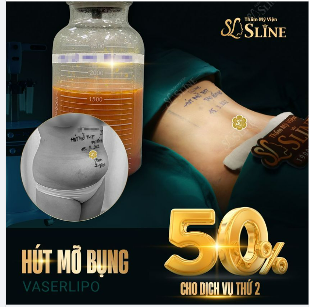  Hút mỡ bụng CHỈ VỚI 18,5TR TRỌN GÓI.