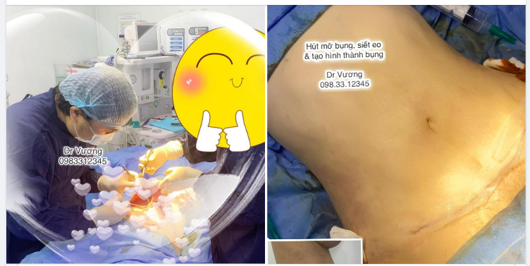 Hút mỡ bụng, siết eo & tạo hình thành bụng với Dr Vương !