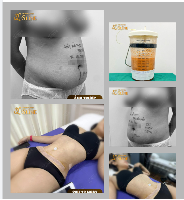 Hút mỡ siết eo sau 12 ngày Sẽ ĐẸP như thế này đây..