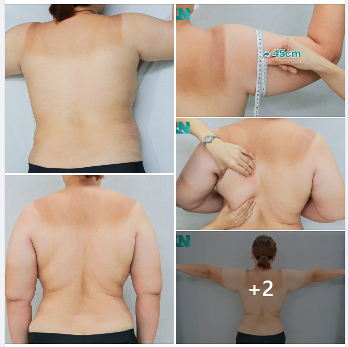  HÚT MỠ TẠO DÁNG THẨM  MỸ VÙNG TAY LƯNG NÁCH CHO CHỊ KH 9X, ĐÃ HÚT MỠ BỤNG 1 THÁNG TRƯỚC. 