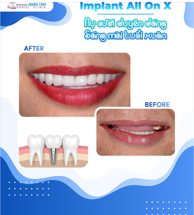 IMPLANT ALL ON X  NỤ CƯỜI DUYÊN DÁNG - SÁNG MÃI TUỔI XUÂN