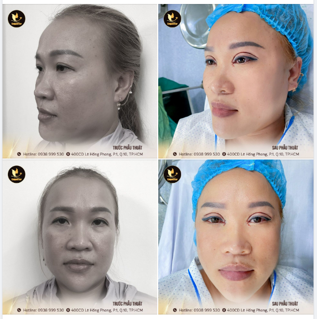 KẾT QUẢ CA CẮT MÍ TRÊN + MỞ GÓC MẮT TRONG