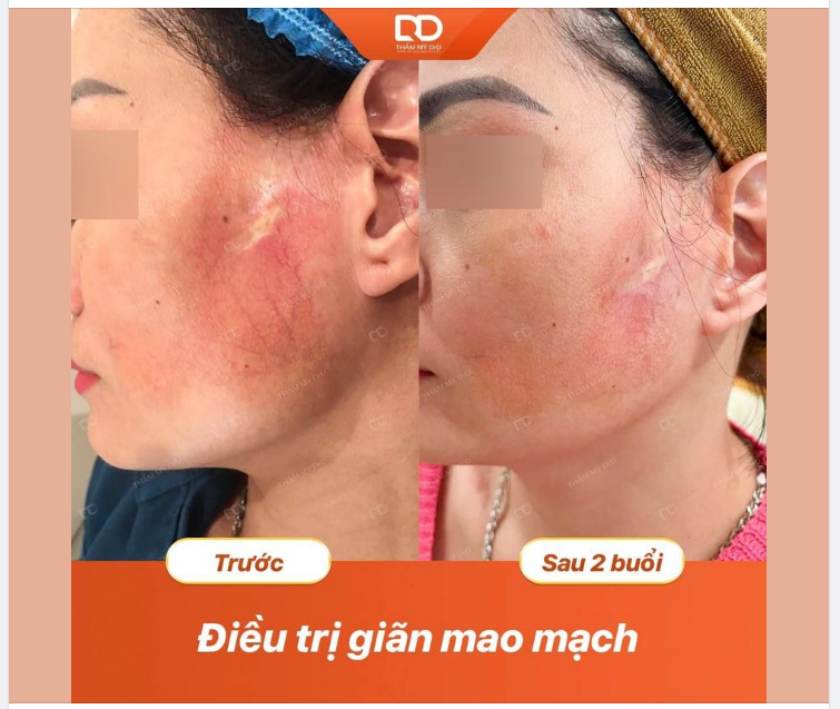 KẾT QUẢ ĐẦY BẤT NGỜ SAU 2 BUỔI ĐIỀU TRỊ GIÃN MAO MẠCH BẰNG CÔNG NGHỆ FOTONA 4D