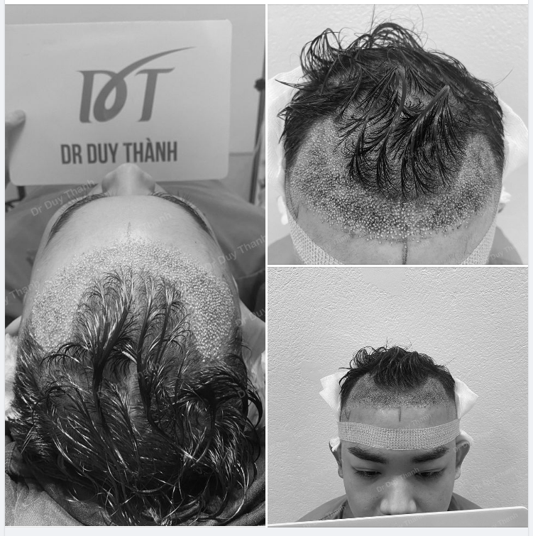 KẾT QUẢ NGAY SAU CẤY 2000 NANG TÓC HẠ THẤP ĐƯỜNG CHÂN TÓC NHÉ, BOY QUY NHƠN.