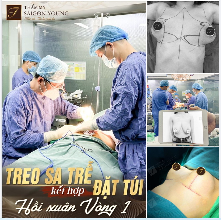 Kết quả sau 90 phút Bs Tươi thực hiện, có thể thấy rõ sự thay đổi ngoạn mục về V1 của chị khách hàng.