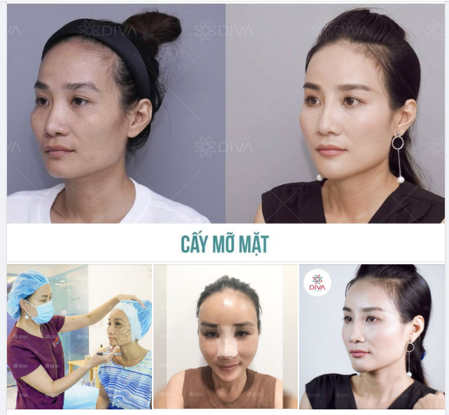 KẾT QUẢ SAU CẤY MỠ COLEMAN, NÂNG MŨI NHƯ THẾ NÀO