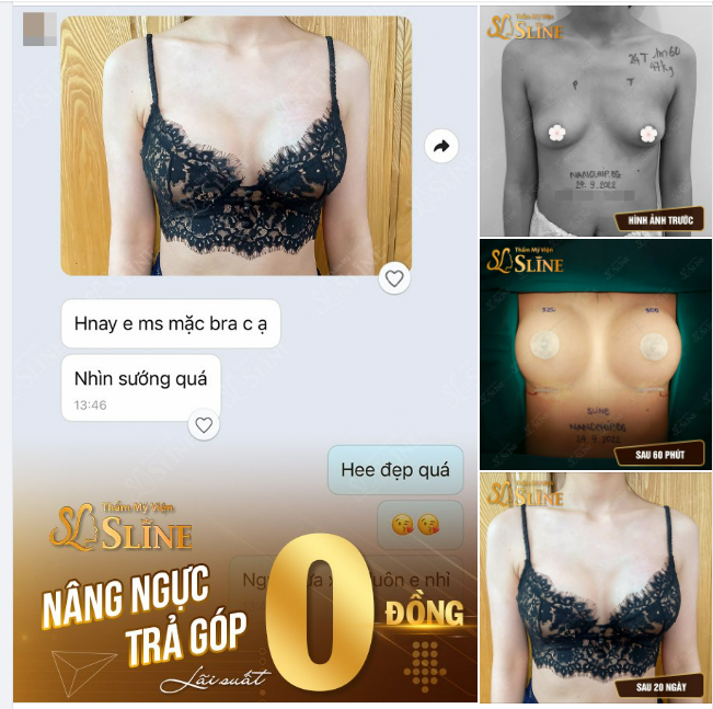 kết quả nâng ngực sau 20 ngày thực hiện bởi Ekip Sline