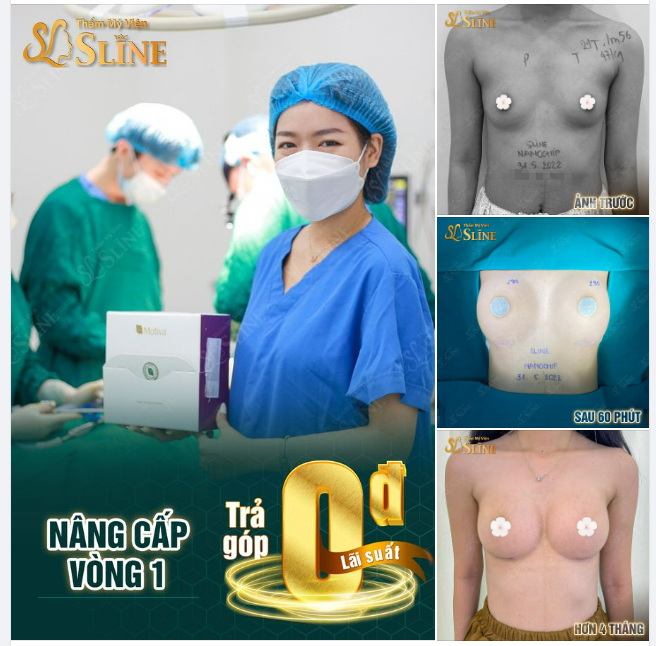 KẾT QUẢ Nâng cấp vòng 1 sau 4 tháng với Ekip Thẩm Mỹ Viện Sline, vòng 1 căng tròn gợi cảm