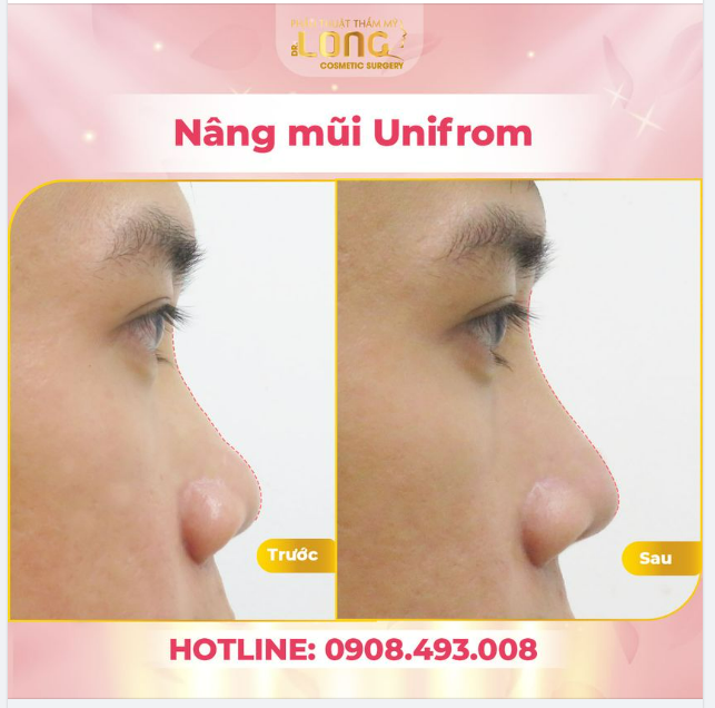 Khác biệt to lớn hơn  Nhìn kết quả của khách hàng sau khi NÂNG MŨI UNIFORM