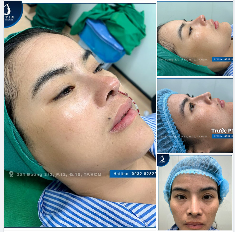 Khắc phục mũi sửa hỏng, lệch, lộ sóng, bóng đỏ cho chị khách từng nâng mũi ở nơi khác nhưng không thành công