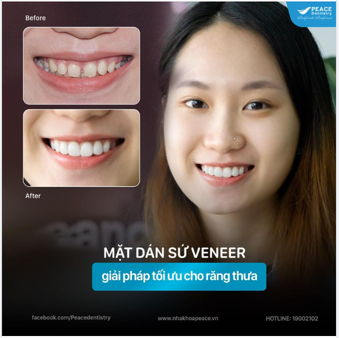 KHẮC PHỤC RĂNG THƯA VÀ BẢO TỒN TỐI ĐA RĂNG THẬT VỚI MẶT DÁN SỨ VENEER