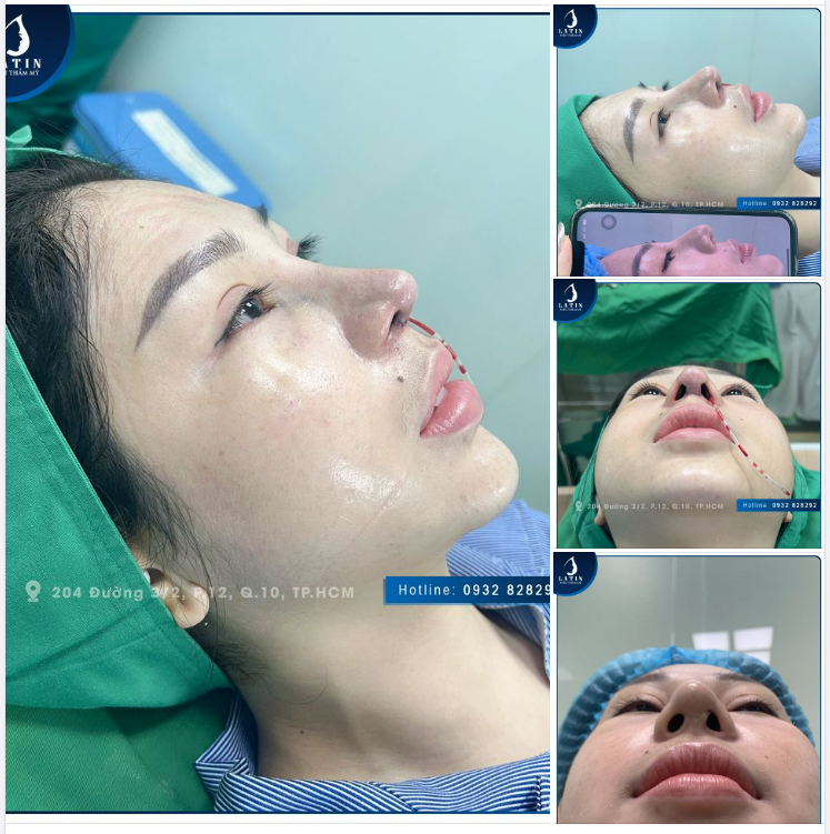 Khắc phục thành công tình trạng mũi bao xơ cho khách hàng đã từng nâng mũi ở nơi khác