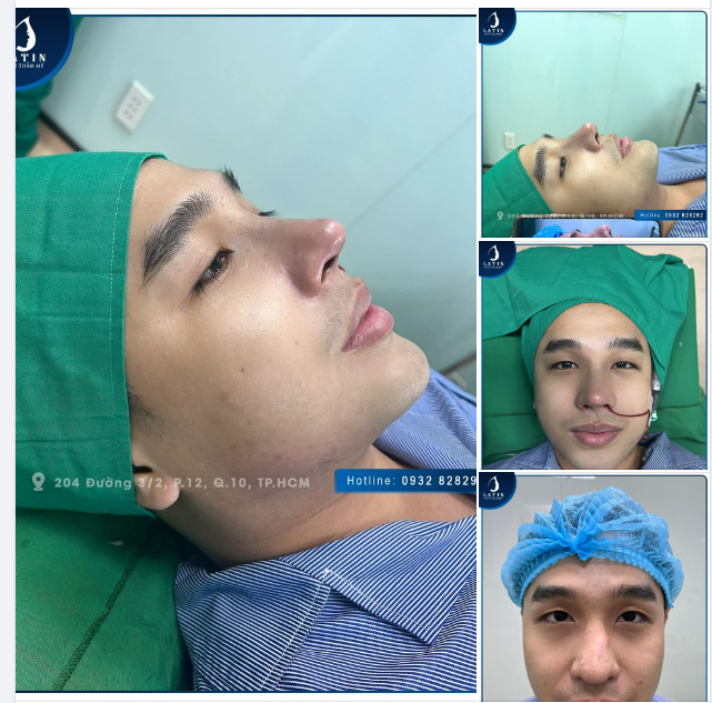 Khắc phục thành công tình trạng mũi gồ, mũi khoằm cho khách hàng nam giới