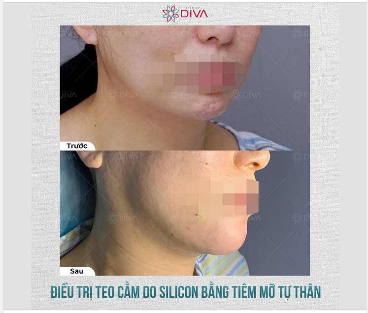 KHẮC PHỤC TÌNH TRẠNG CẰM NHĂN NHEO CO RÚM BẰNG PHƯƠNG PHÁP TIÊM MỠ COLEMAN
