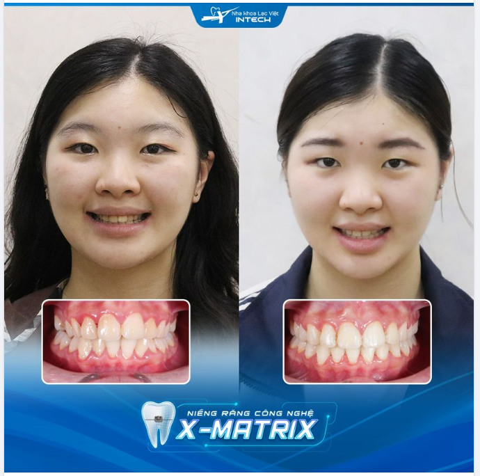 KHẮC PHỤC TÌNH TRẠNG RĂNG HÔ NHỜ NIỀNG RĂNG CÔNG NGHỆ X-MATRIX