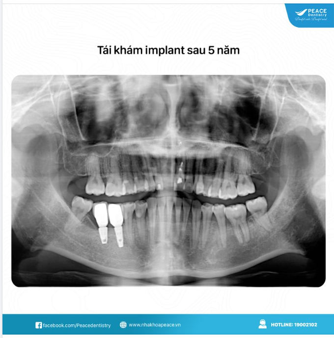 Khách hàng quay lại tái khám implant sau 5 năm