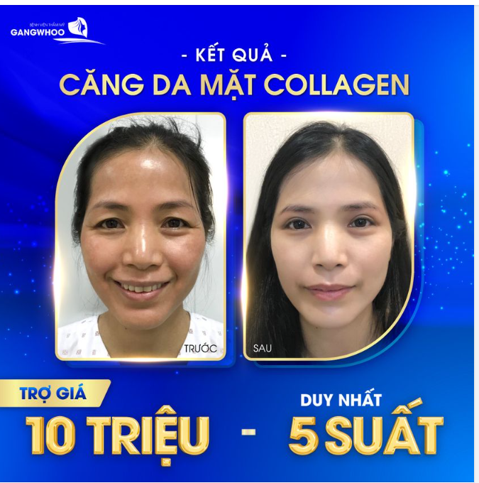 KHÁCH HÀNG SAU KHI CĂNG DA MẶT BẰNG CHỈ COLLAGEN