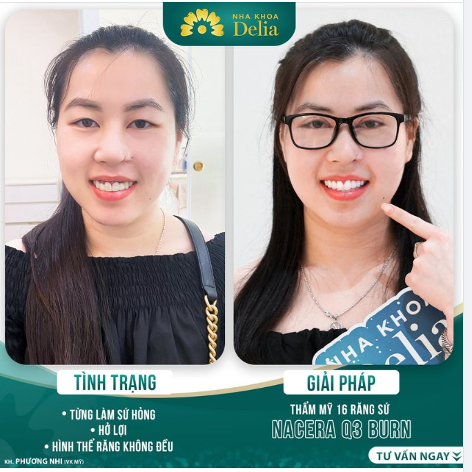 Khách hàng Việt Kiều đặt niềm tin tại Delia sau 2 lần làm răng sứ hỏng tại Mỹ!