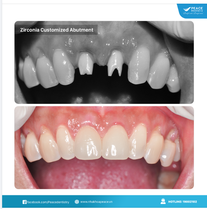 KHI NÀO CẦN CHỈ ĐỊNH CUSTOMIZED ABUTMENT?