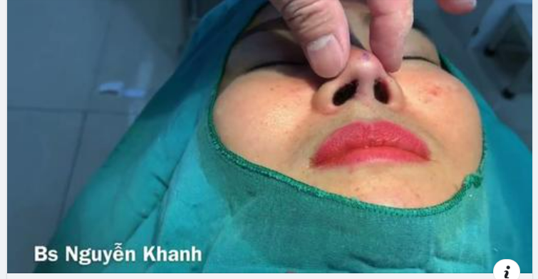KHI NÀO CẦN NÂNG MŨI BẰNG SỤN CÂN MÔNG