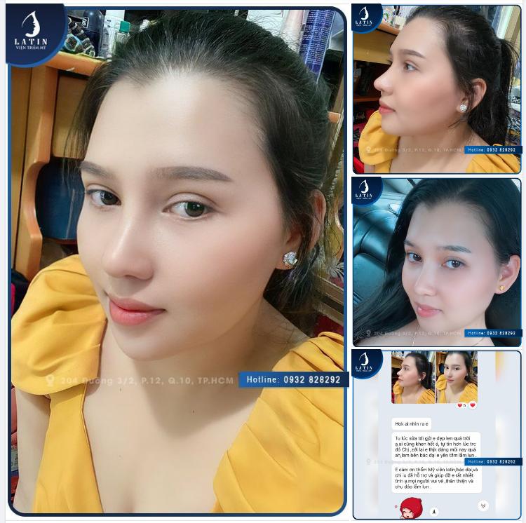 Khoe một chút feedback khách hàng nâng mũi tại Latin