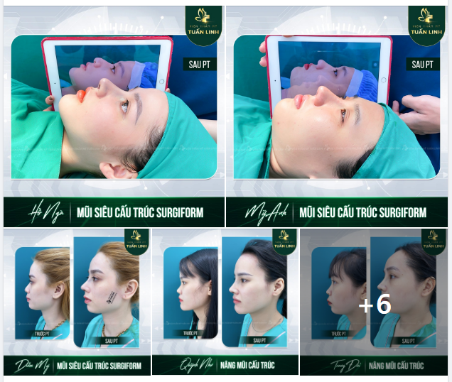 Khoe ngay hình ảnh khách hàng nhà Tuấn Linh sau 90 phút phẫu thuật đây ạ