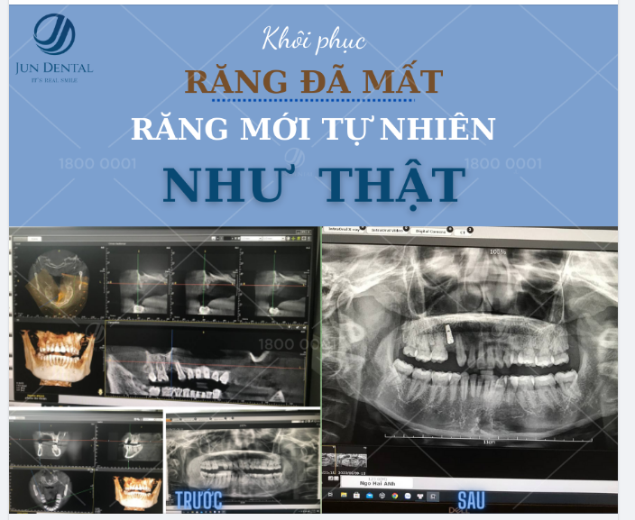 KHÔI PHỤC RĂNG ĐÃ MẤT - LẤY LẠI TỰ TIN VỚI CẤY GHÉP IMPLANT CÔNG NGHỆ CAO