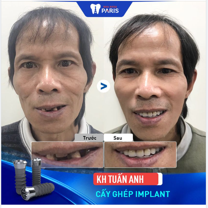 KHÔI PHỤC RĂNG TOÀN HÀM ALL ON CHO KH TUẤN ANH