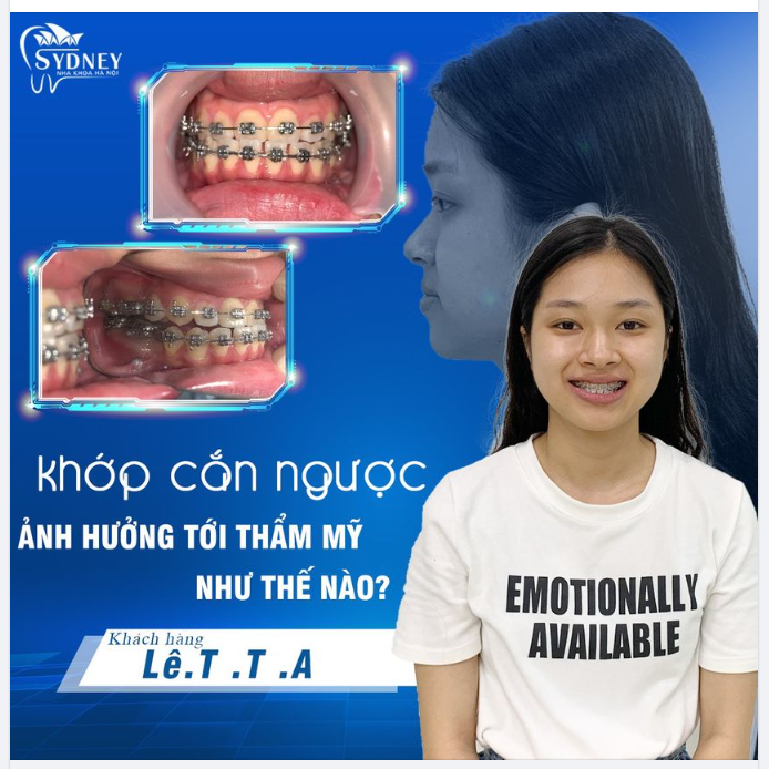 Khớp cắn ngược ảnh hưởng tới thẩm mỹ như thế nào?