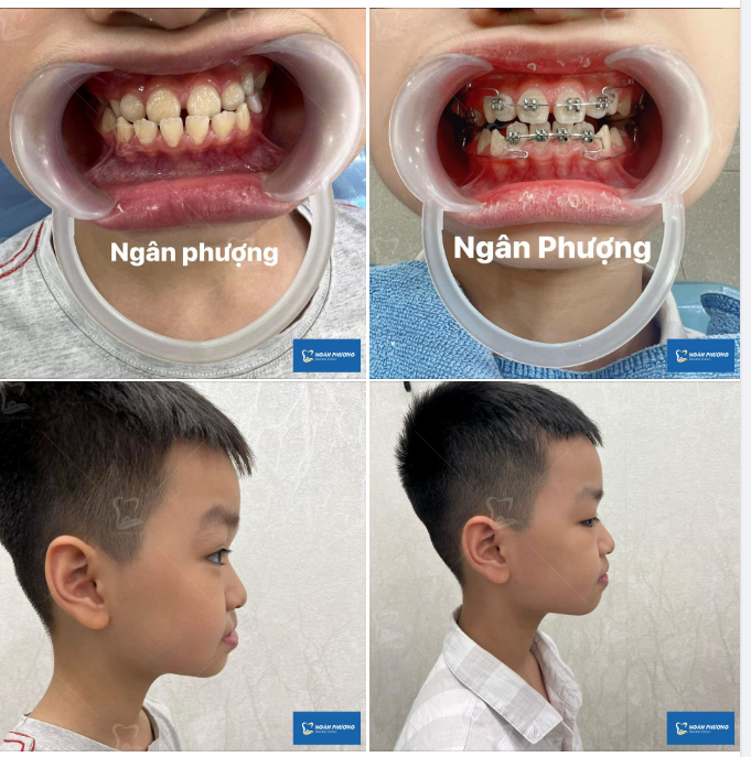 Khớp cắn ngược khi nào nên niềng răng?