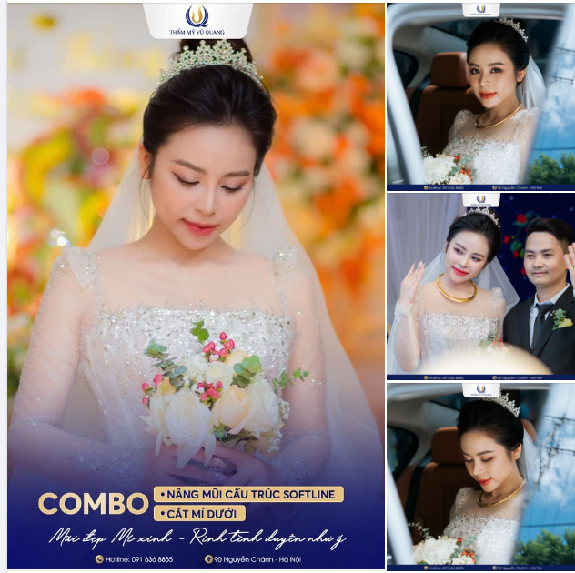 Kiều Trang trở thành cô dâu đẹp nhất sau Combo Nâng mũi cấu trúc Softline + Cắt mí dưới.