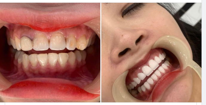 Làm đẹp hàm răng chưa bao giờ là muộn và hãy thay đổi khi bạn có thể nhé!