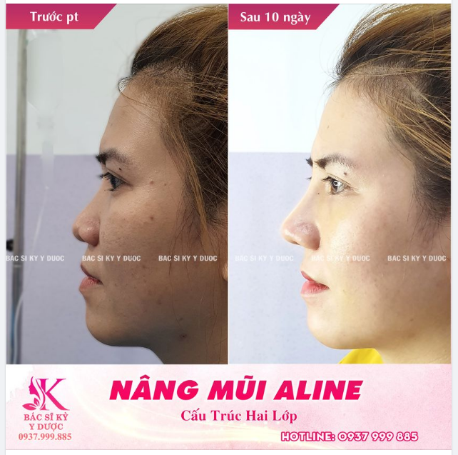 LÀM ĐẸP KHÔNG ĐAU - DÁNG MŨI CAO THANH, PHÙ HỢP GƯƠNG MẶT.