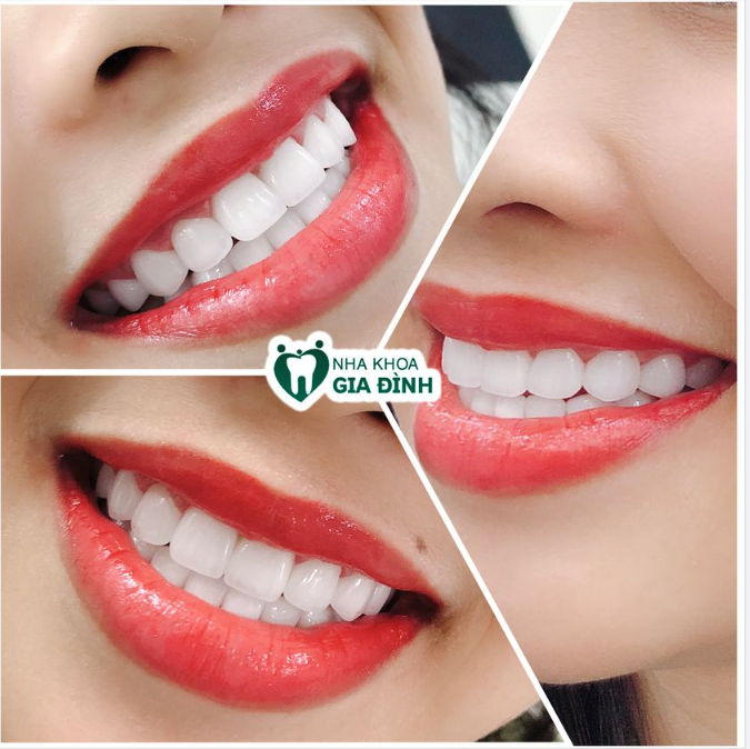 LÀM MỘT LẦN ĐỂ ĐẸP TRỌN ĐỜI CÙNG RĂNG SỨ THẨM MỸ TẠI NHA KHOA GIA ĐÌNH