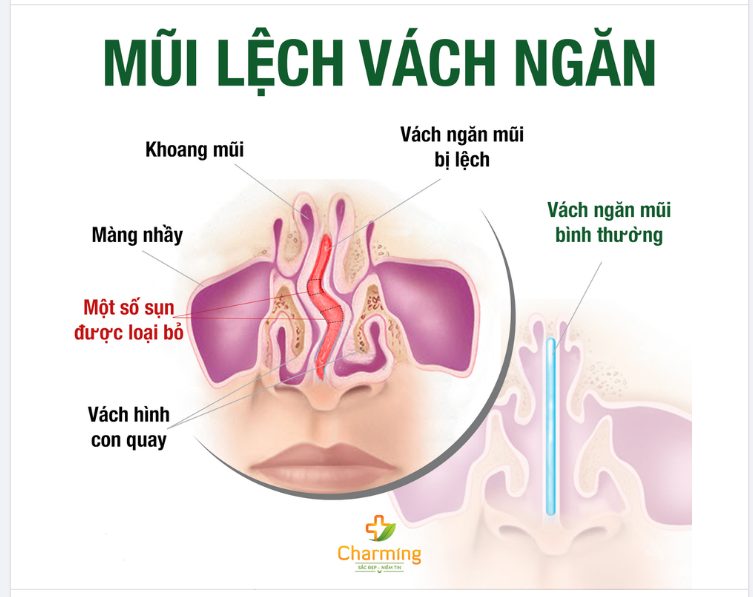 LỆCH VÁCH NGĂN MŨI CÓ ĐƯỢC NÂNG MŨI KHÔNG
