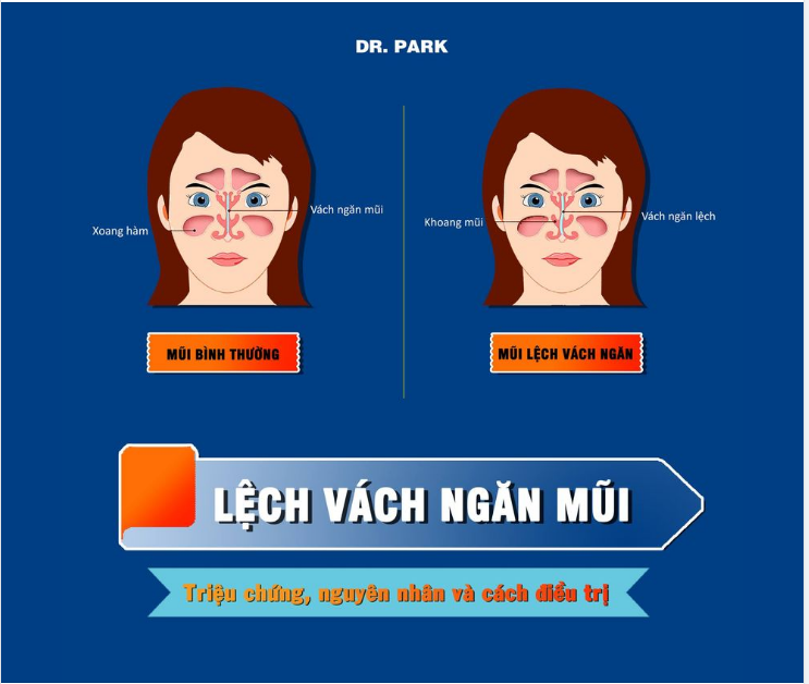 LỆCH VÁCH NGĂN MŨI - NGUYÊN NHÂN VÀ CÁCH ĐIỀU TRỊ