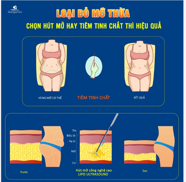 LOẠI BỎ MỠ THỪA - CHỌN HÚT MỠ HAY TIÊM TINH CHẤT
