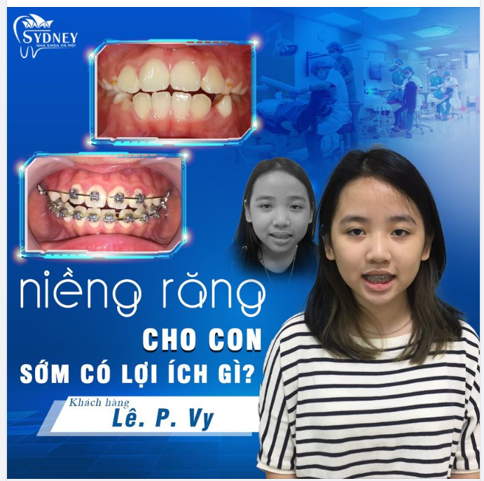 Lợi ích khi niềng răng sớm