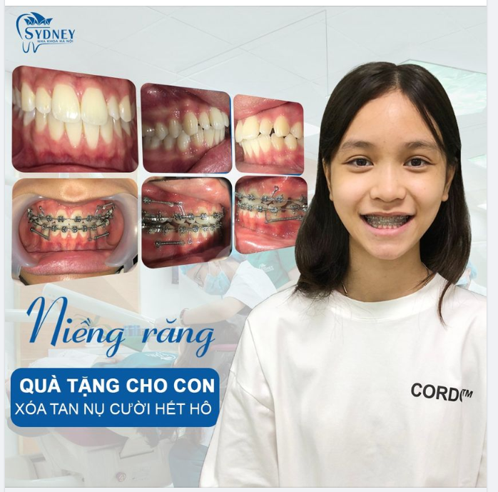 Lợi ích việc niềng răng sớm cho trẻ