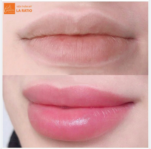 LỘT BỎ ĐÔI MÔI THÂM SẠM LẤY LẠI SỰ TỰ TIN TRONG CUỘC SỐNG