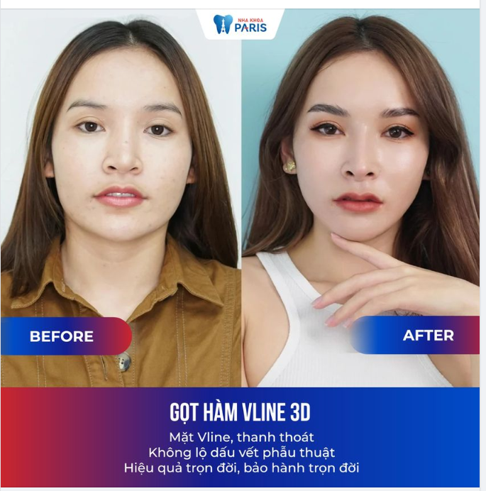 Lột xác, đổi đời sau khi gọt hàm Vline tại Paris